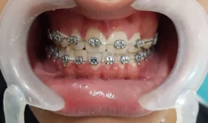 Brackets Metálico Estético 